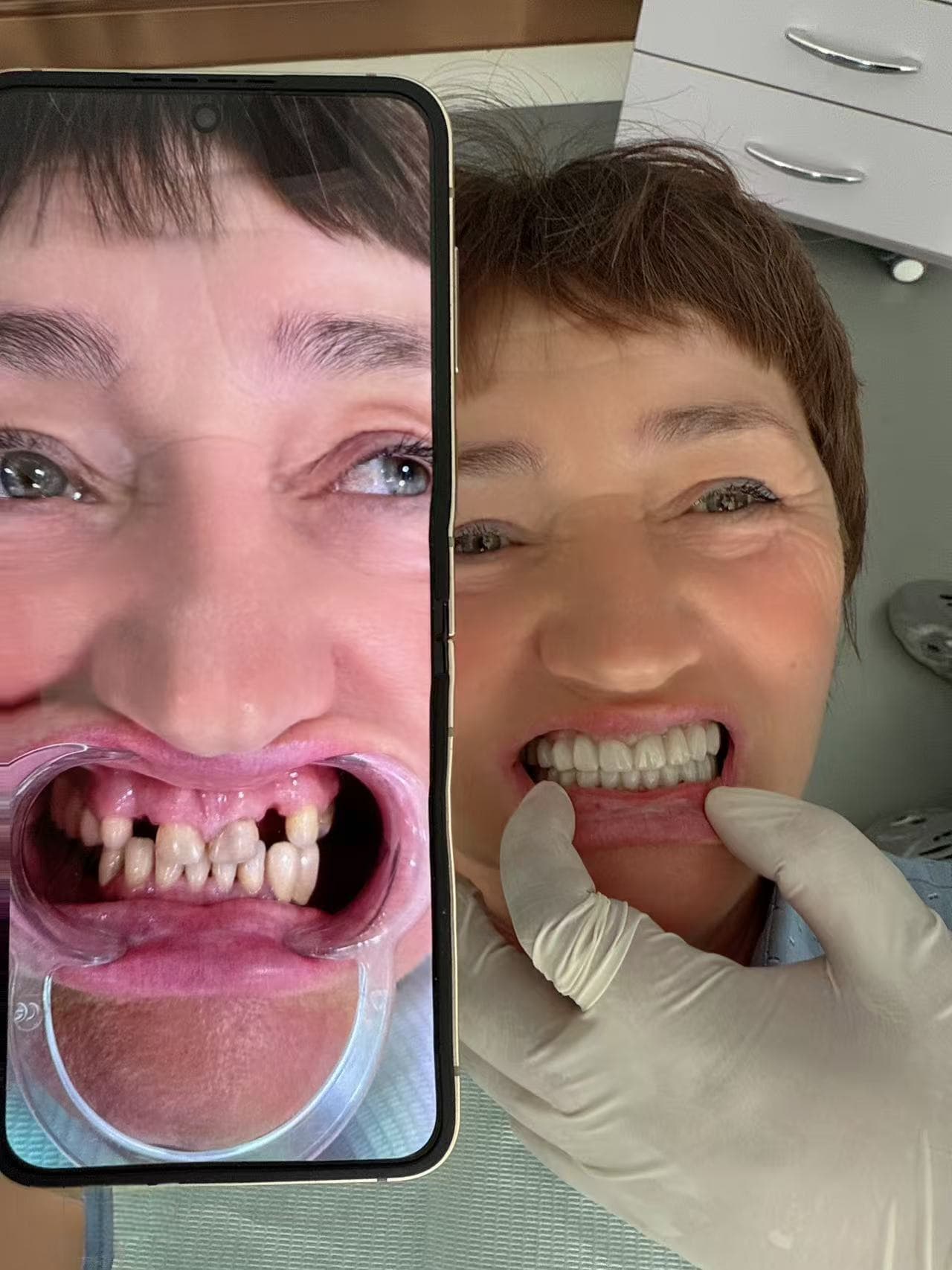 Имплантация  «под ключ» с улучшенной приживаемостью